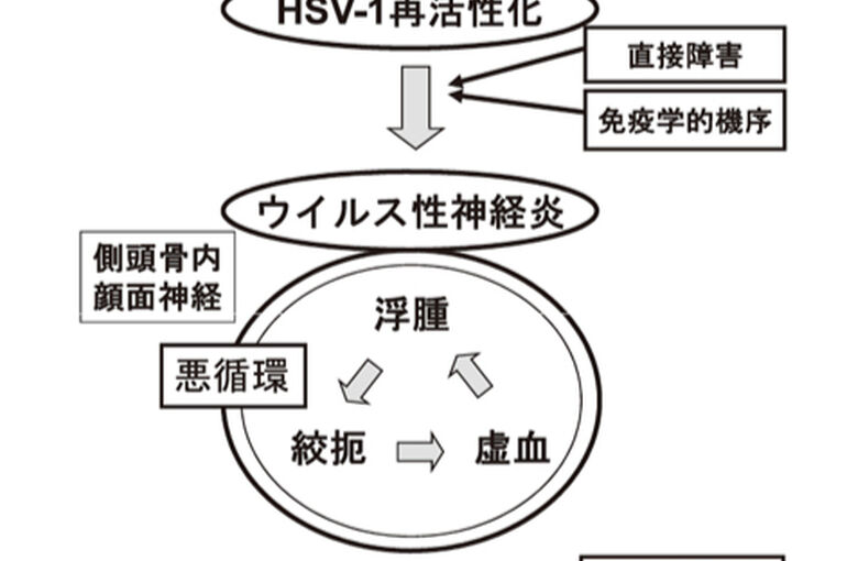 顔面神経麻痺メカニズム