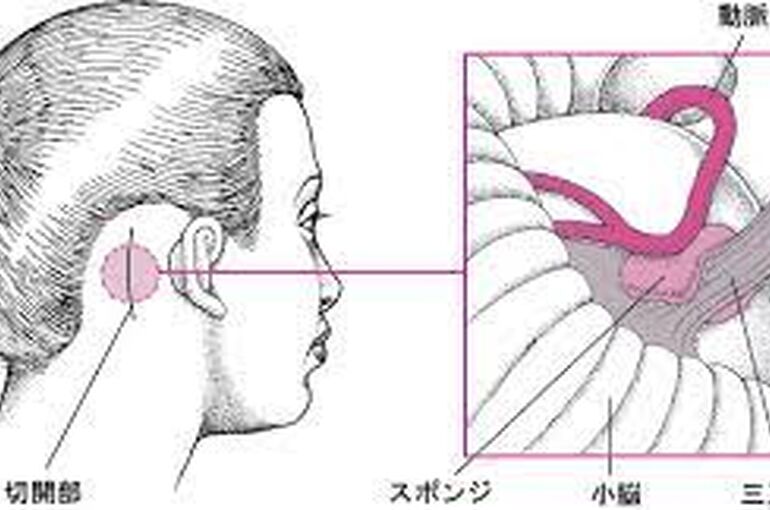 減圧手術