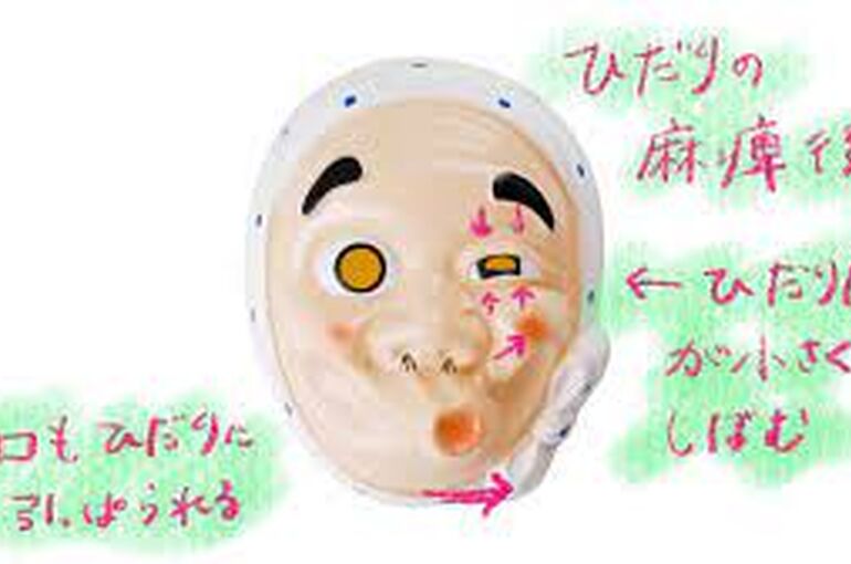 拘縮