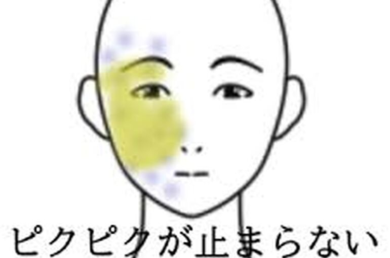 顔面けいれん
